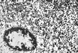 F, 79y. | paraganglioma … intestinal serosa